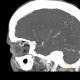 Ophthalmic artery, dilated: CT - Computed tomography
